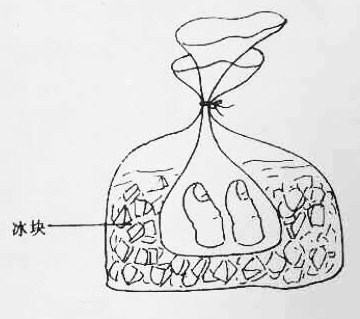 遇到断指,断掌,断肢等外伤一定要正确处理伤口及时送医千万别使用烟丝