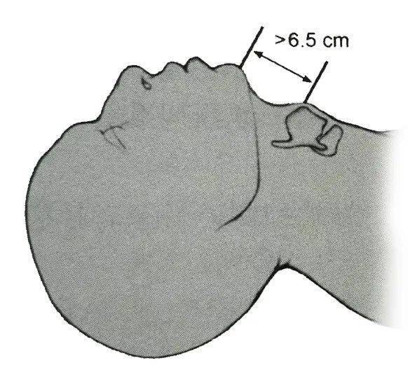 甲颏距离:是头在伸展位时,测量自甲状软骨切迹至下颚尖端的距离.
