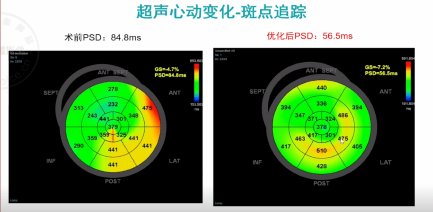 心讲座|朱天刚:pr显著延长合并qrs波增宽的心衰——crt治疗显奇效_左