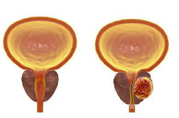 【薦讀】前列腺增生別忽視,治療不當或變為前列腺腫瘤,幾個症狀提示你
