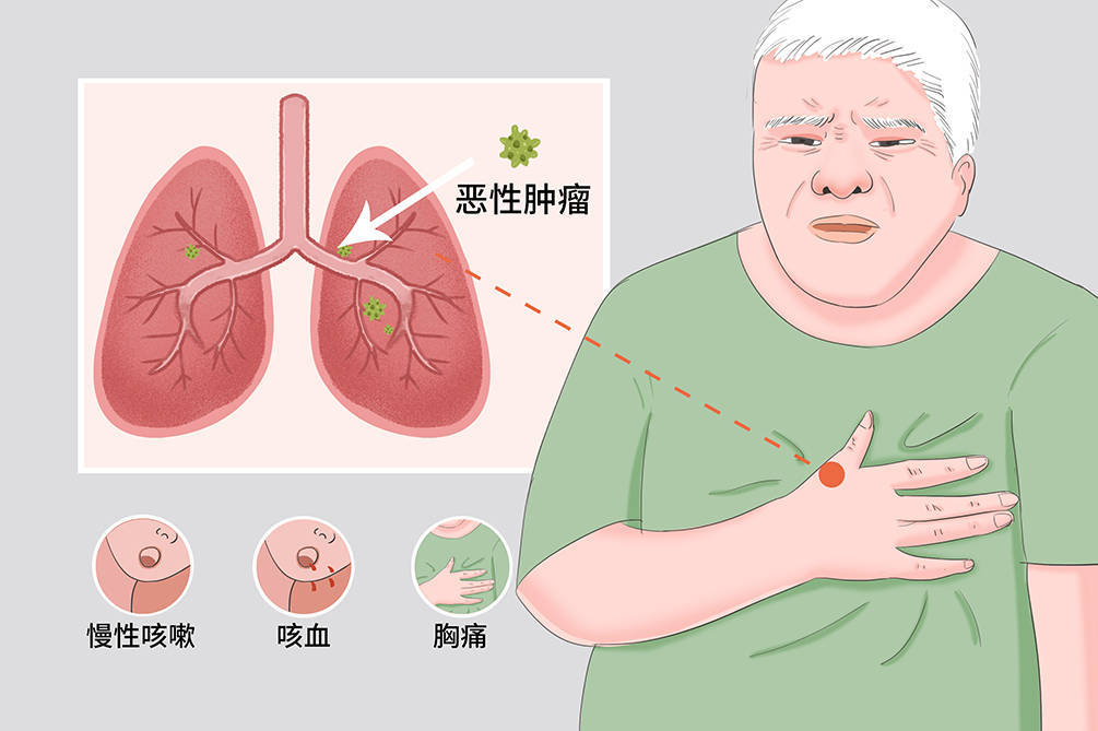 指南【高尚健康】什么症状表现为肺癌?