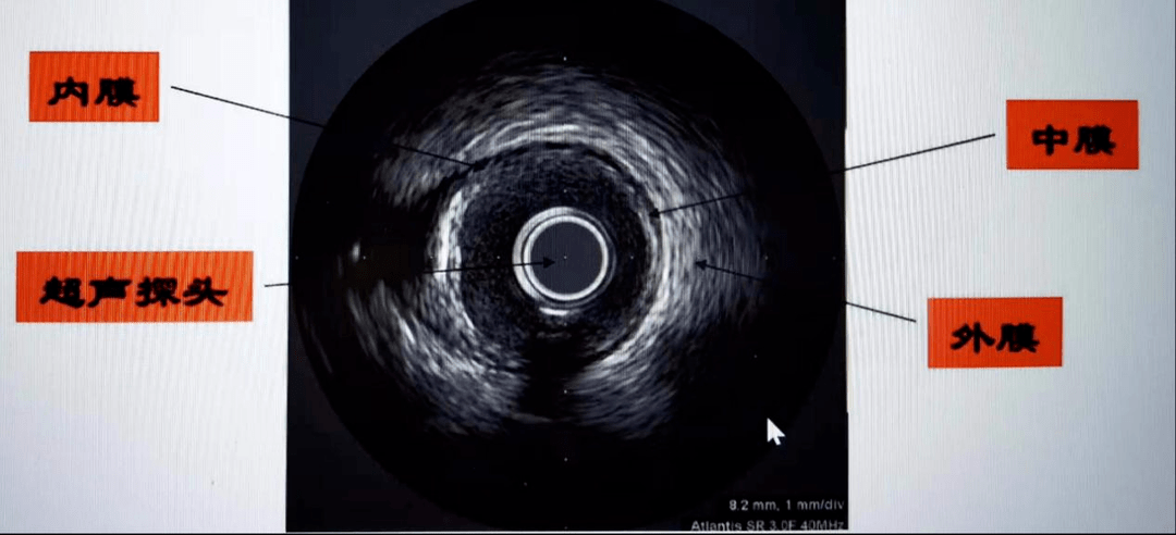 【附三医讯】血管内超声(IVUS)——心内科的“火眼金睛_检查_技术_支架