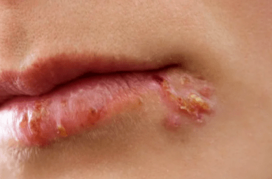 口周起泡没那么简单,注意警惕单纯疱疹的来袭!