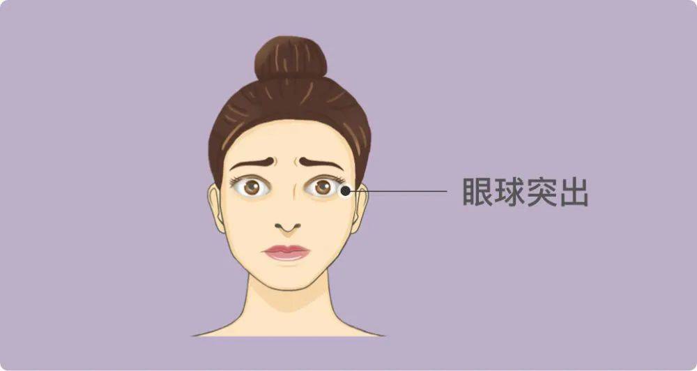 董方武主任:甲亢远比你知道的要严重,一旦引起突眼,治疗难度也随之