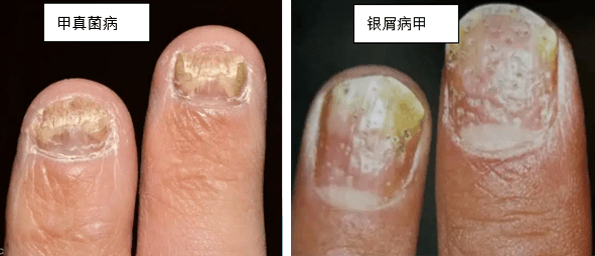 【医文医话】世界银屑病日:如何区分灰指甲与银屑病甲?