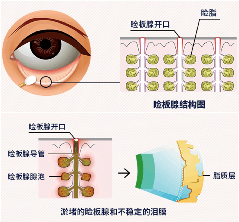 而当发生睑板腺功能障碍时,油出问题了,水分就会过快蒸发,就可能会