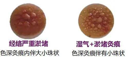 艾灸后起泡意味着什么?90%的人还傻傻不清晰