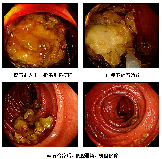 【友誼消化窺鏡】