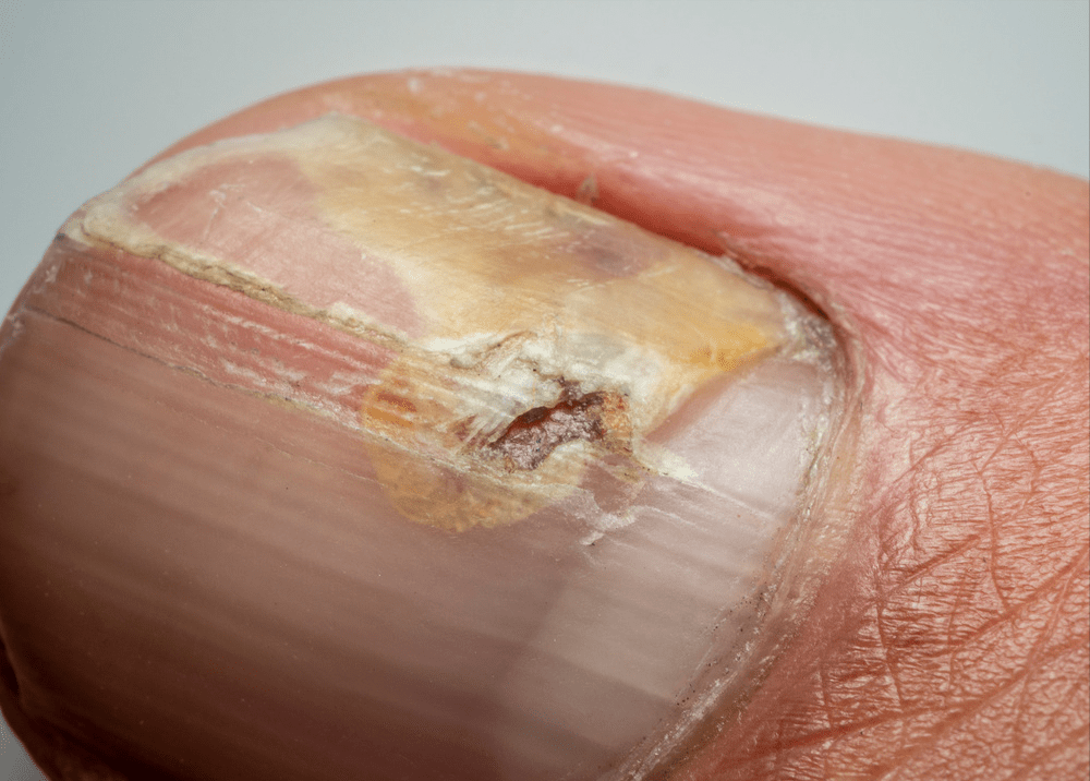 ④指甲内陷如果指甲表面出现一条线形的凹陷,那么很可能是"博氏线".