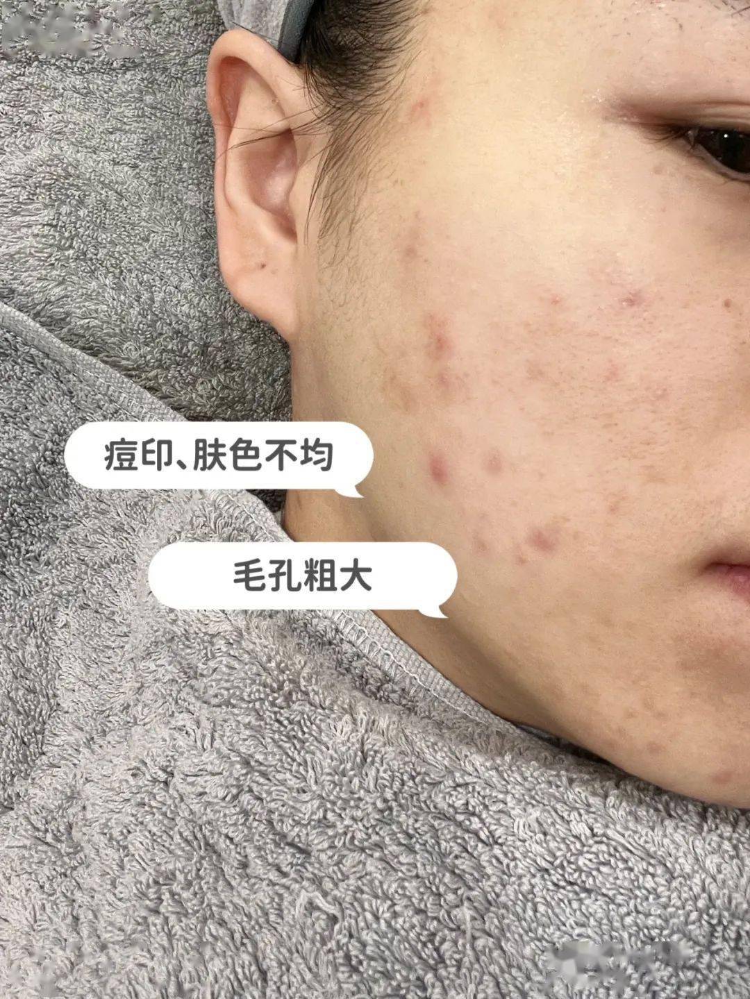 像bobo脸上痘痘痘印的区域毛孔粗大的区域敏感的区域医生都分别
