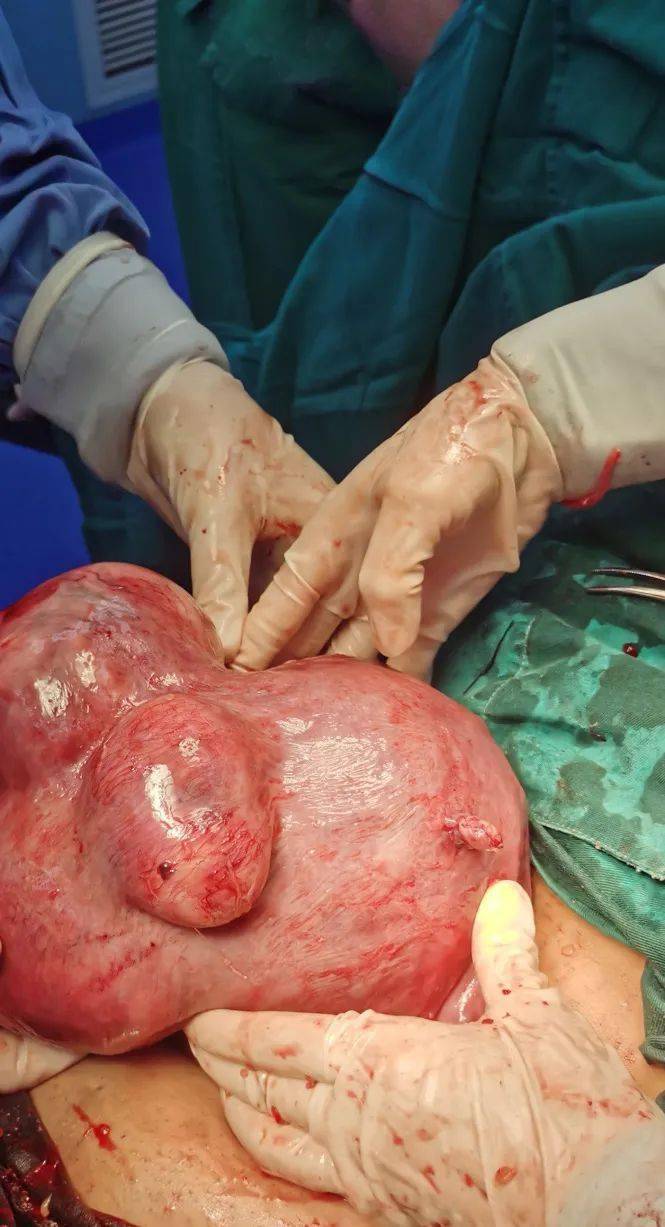 【angel 手术室】一台剖宫产手术= 1个胎宝  5个子宫肌瘤?