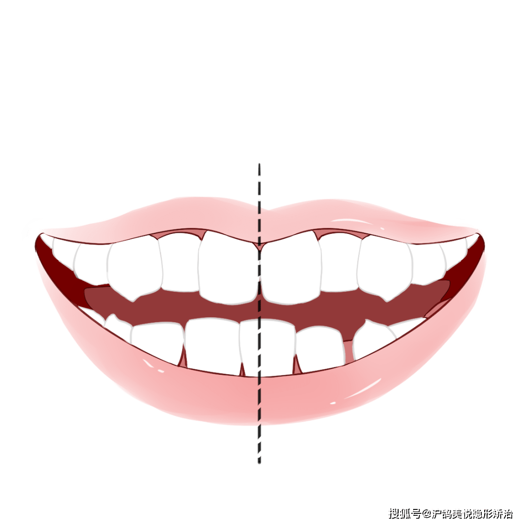 牙中线是一条假想的直线,该线过中切牙近中面,将牙弓分为左右对称的两