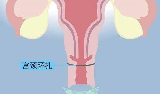 宫颈管短图片图片