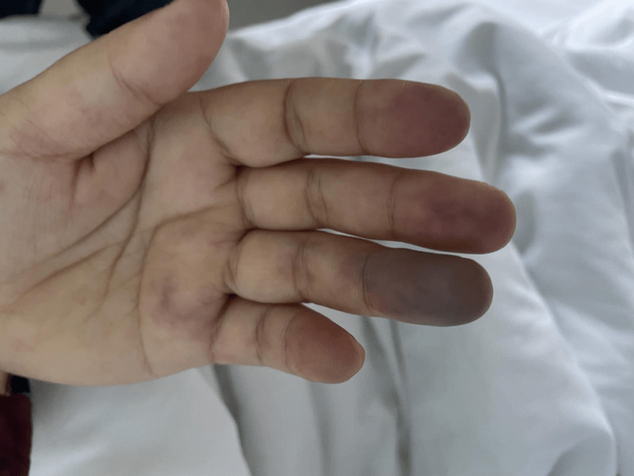 47岁女子手指发黑肿胀疼痛,济南市三院妙手追凶
