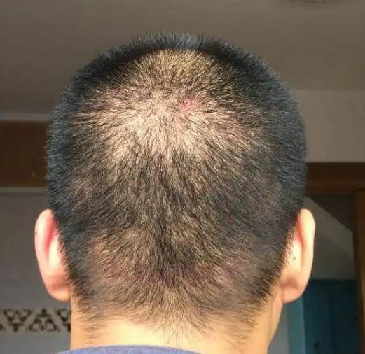 10年贵州13岁男孩头上莫名长虫子,专家束手无策,记者却发现端倪_黄伦