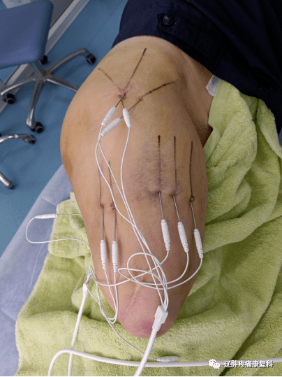 新疗法|内热针技术治疗幻肢痛