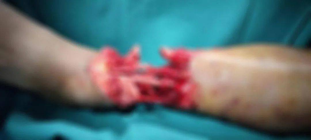 惨烈车祸撞断左脚,危急之下,他从原阳赶到郑州寻求生门……_李哥_救治