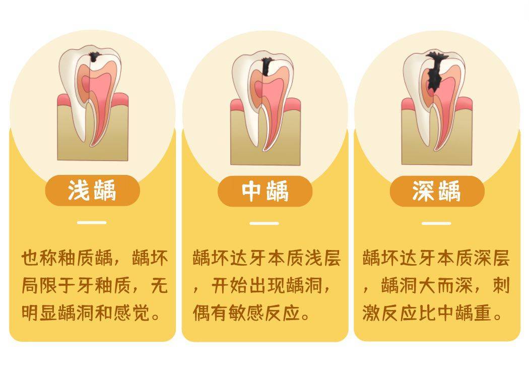 怎么判断龋齿严重程度图片