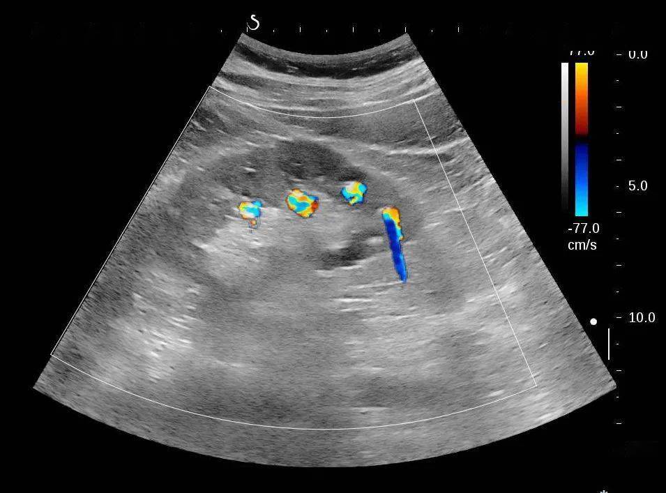 痛风肾超声图片图片