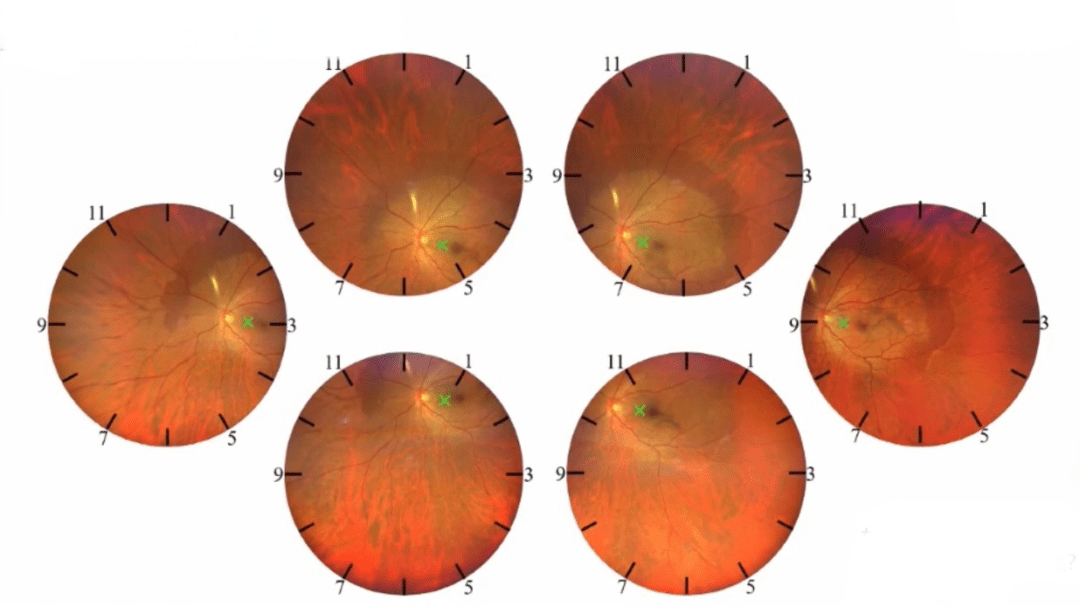 超广角眼底照相机 | 拍摄技巧(超实用)_患者_镜头_方法