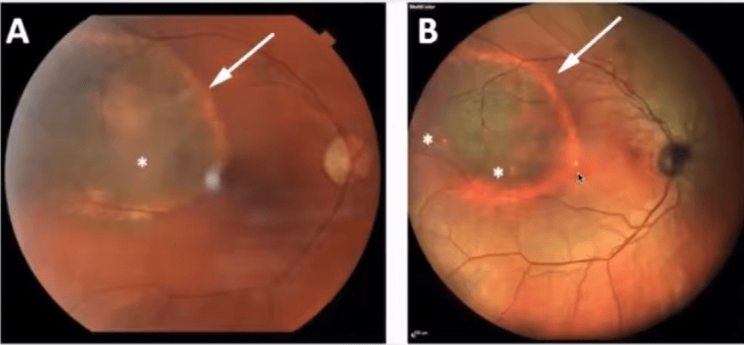 脉络膜黑色素瘤,在炫彩中,由于瘤体内含有黑色素,所以吸收红外激光呈
