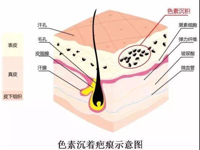 较轻程度的疤痕处理方法(增生性疤痕和疤痕疙瘩的处理方法)