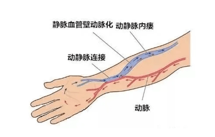 長期透析患者為什麼要做動靜脈內瘻?_手術_治療_血管