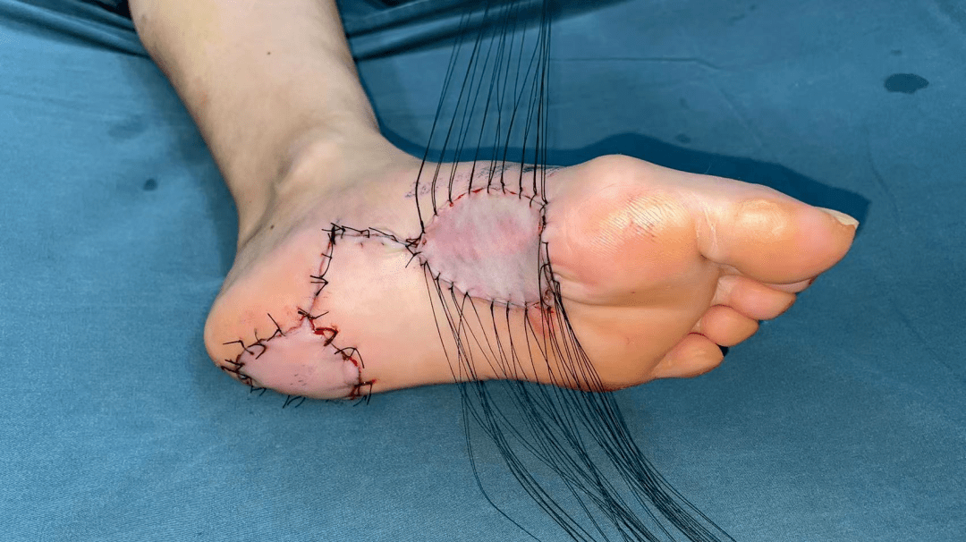 【围观】医生居然给脚底整容?_创面_整形_手术