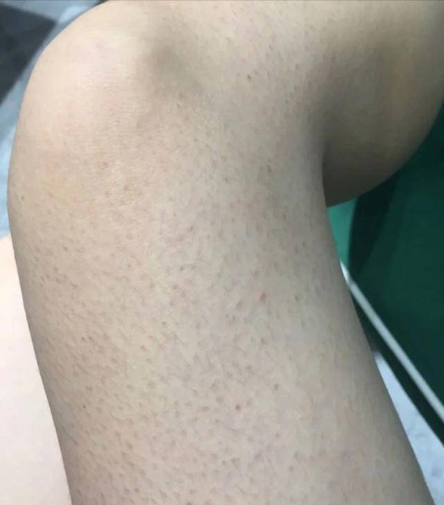 鸡皮肤后天怎么得的(鸡皮肤改善后可以看的出吗)
