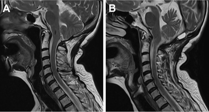 环之外,彻底清除突出或脱垂的髓核和增生的骨质来解除对神经根的压力