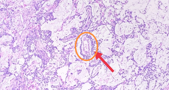 图 卵黄囊瘤中典型的形态结构称为schiller-duval体,由单层立方或柱状