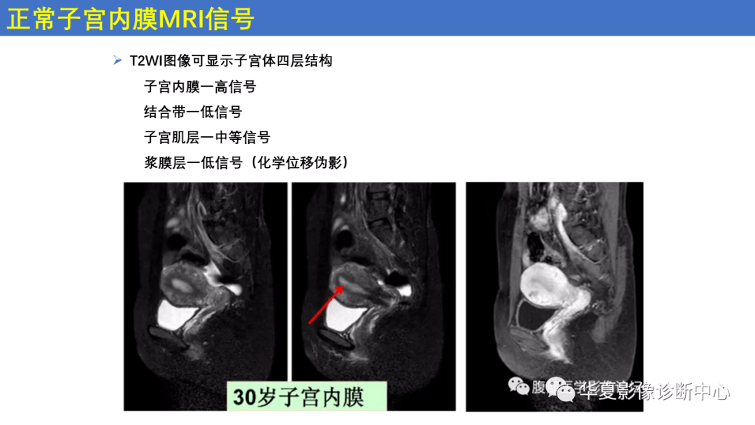 子宫内膜疾病的MRI诊断及鉴别_影像_平台_微信