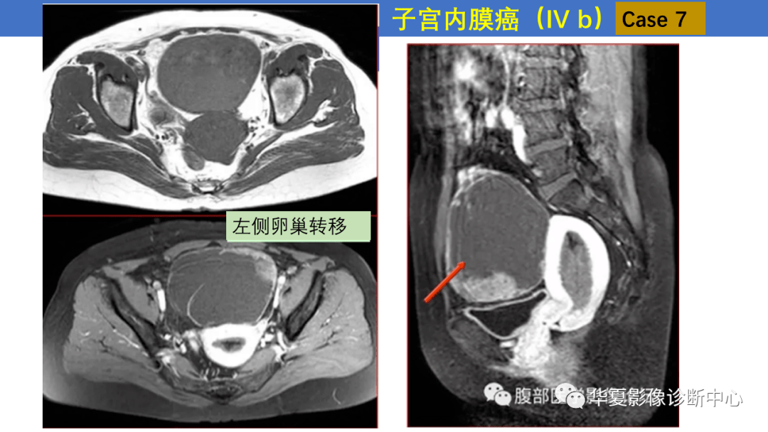 子宫内膜疾病的MRI诊断及鉴别_影像_平台_微信