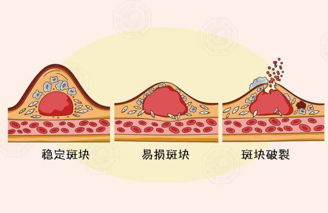 存在於動脈內的粥樣硬化斑塊分為兩種,一種是鈣化斑塊,它比較穩定;另