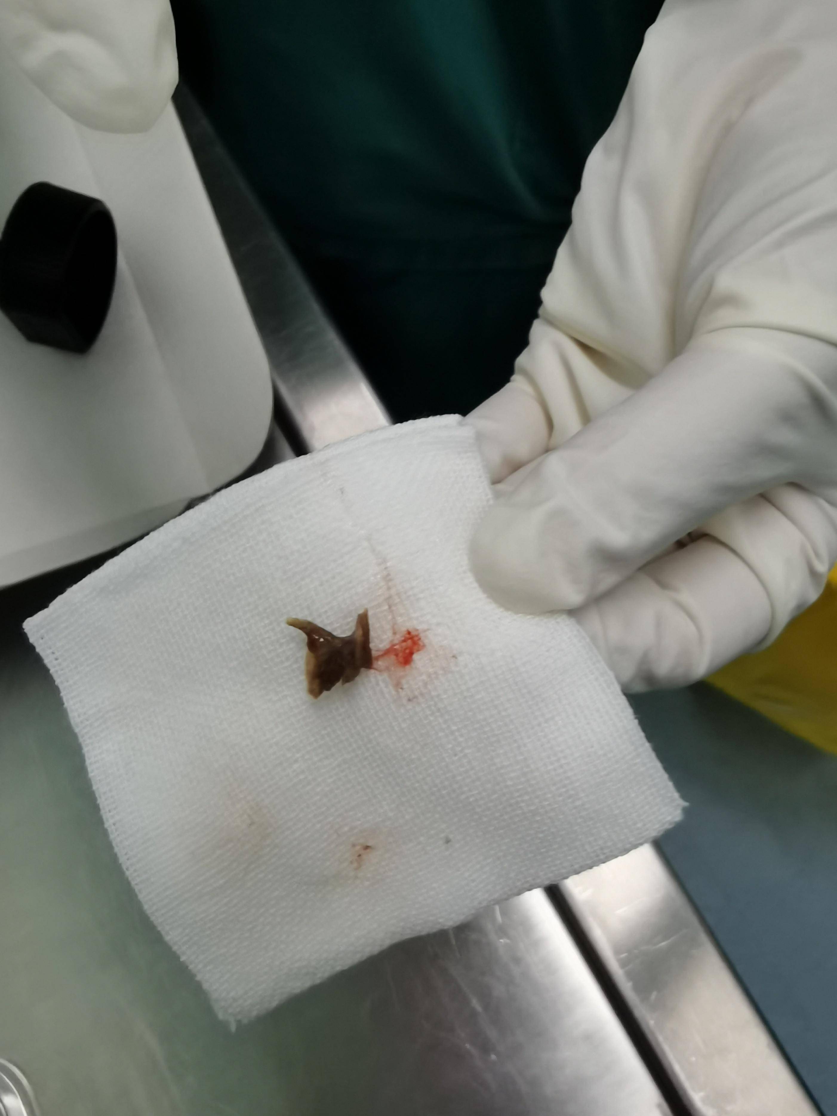 反复咳嗽咳痰1年,原来是鸡骨惹的祸_异物_赵先生_组织