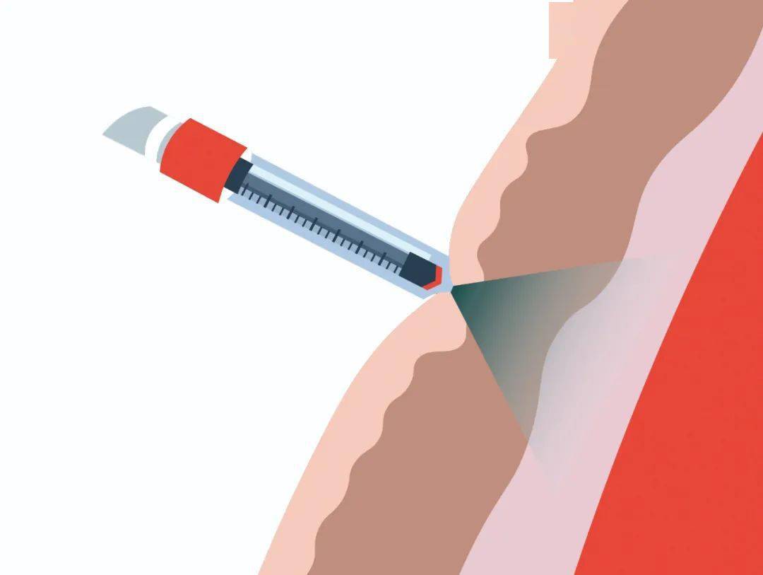 打针的恐怖时刻_药物_注射器_膀胱