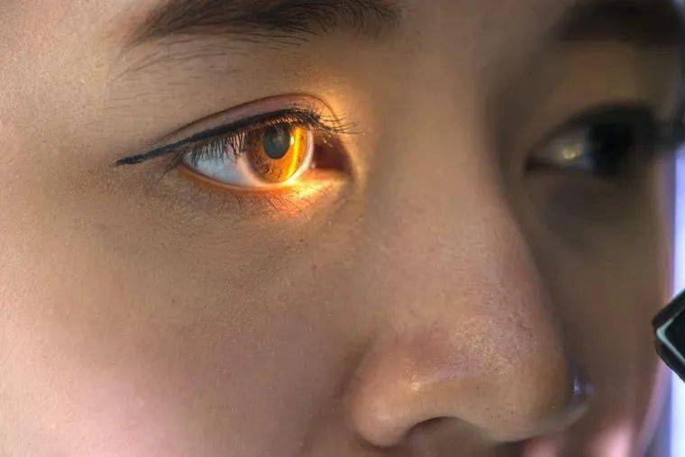 患上眼部黑色素瘤,澳女眼球被切除!医生警告:夏天必做这件事!