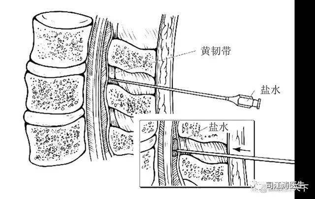 骶管注射解剖图图片