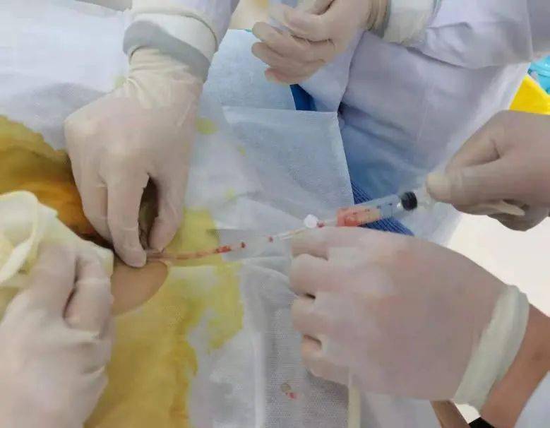 提示左乳头内囊性病灶伴感染可能,随即行超声引导下行置管引流及冲洗