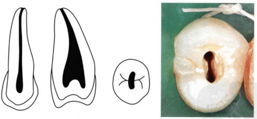 髓室和根管之间没有明显界限,多为单根管,上颌前牙髓腔形态及根管口