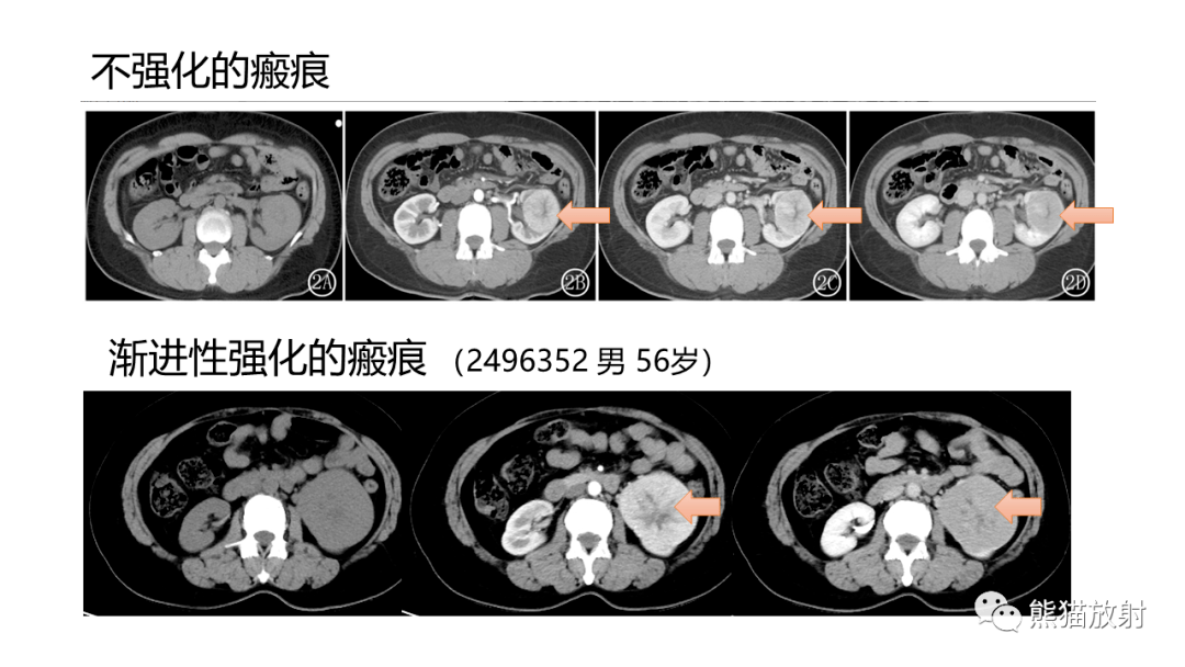 【省立影像读片】肾脏病变2301