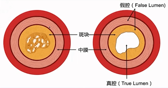 心講座 | 葛雷:冠脈cto手術策略與進展——ctocc cto pci流程圖更新版