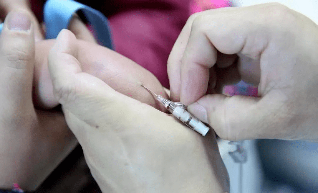 单手退针,学会你就无敌了!_血管_患者_套管