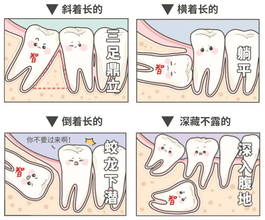 上牙智齿位置图图片