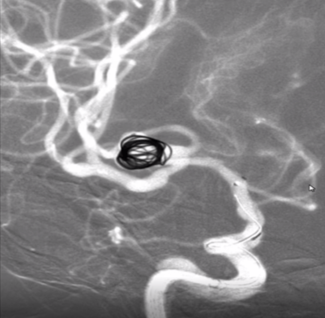 高旭:分叉部动脉瘤isat-c解决方案_支架_血管_mm