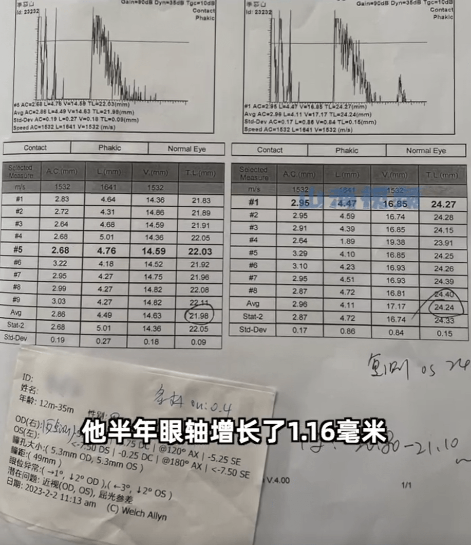 父母高度近视1岁婴儿近视600度