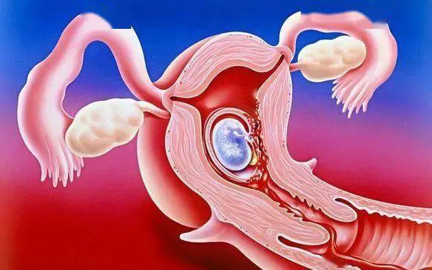 内做人流,就很容易在手术时发生空吸或漏吸,造成手术失败或流产不完全