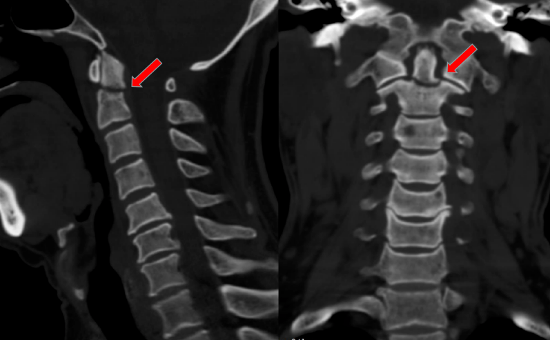 最终为患者制定了手术方案——前入路枢椎齿状突骨折闭合复位螺钉内