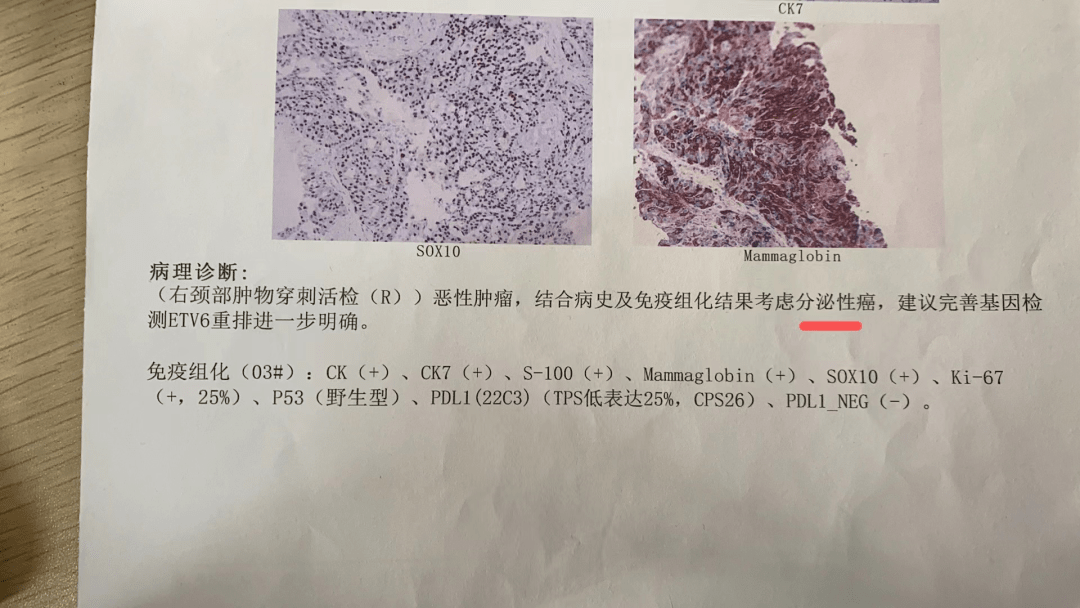 病理报告单 肿瘤图片