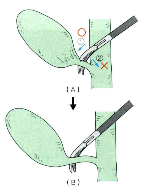 剪开hartmann袋的背侧浆膜后,在calot三角内用分离钳自左向右通过